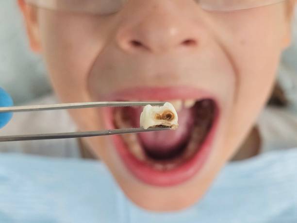 Best Emergency Wisdom Teeth Removal in Gratton, VA